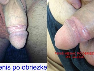Obriezka pred a po - 806999