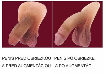 BEFORE Obriezka a augmentácia 1