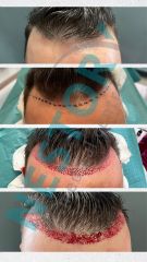 Transplantácia vlasov - NESTORY medical centre