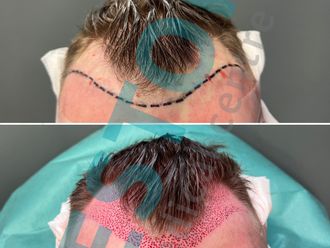 Transplantácia vlasov - 829903