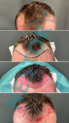 Transplantácia vlasov - NESTORY medical centre