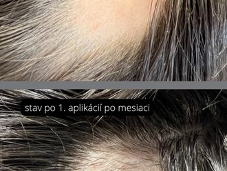 Transplantácia vlasov - 838331
