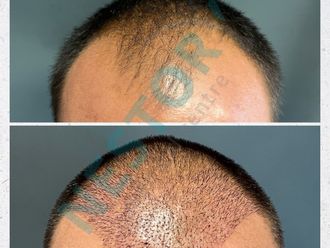 Transplantácia vlasov - 845724