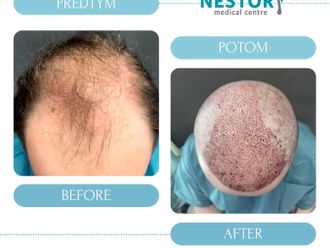 Transplantácia vlasov pred a po - 879483