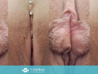 Vaginoplastika pred a po - 802885