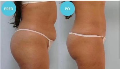 Liposukcia pristrojom BODY JET