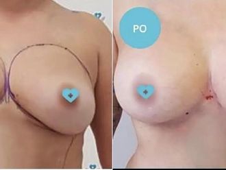 Lipofilling pred a po - 802891