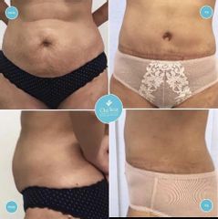 Abdominoplastika brucha