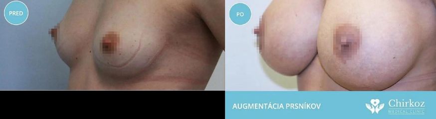 Zväčšenie prsníkov silikónovými implantátmi  / Augmentácia