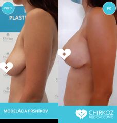 Modelácia prsníkov s augumentáciou
