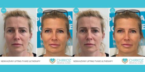 (Ultherapy) Neinvazívny lifting