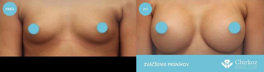 Zväčšenie prsníkov silikónovými implantátmi  / Augmentácia