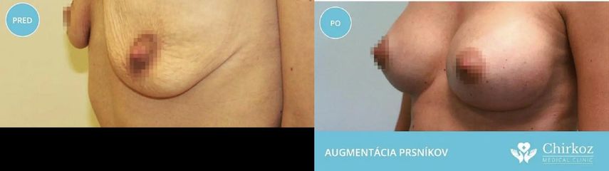 Zväčšenie prsníkov silikónovými implantátmi  / Augmentácia