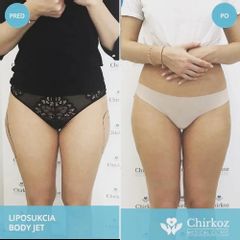LIPOSUKCIA PRÍSTROJOM BODY-JET®
