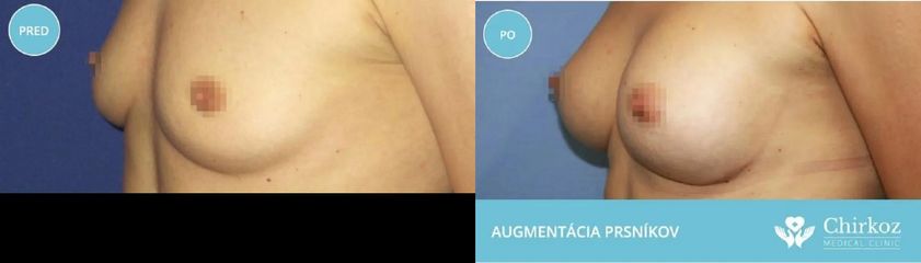 Zväčšenie prsníkov silikónovými implantátmi  / Augmentácia