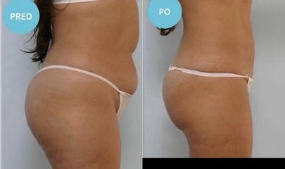LIPOSUKCIA PRÍSTROJOM BODY-JET®