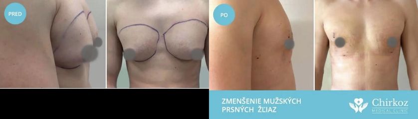 Gynekomastia