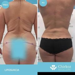 LIPOSUKCIA PRÍSTROJOM BODY-JET®