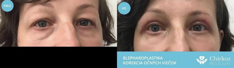 Korekcia očných viečok / Blepharoplastika