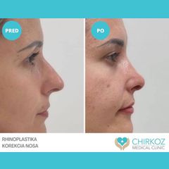 Operácia nosa (Rhinoplastika) - Chirkoz Medical Clinic