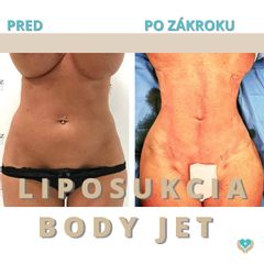 Liposukcia - Chirkoz Medical Clinic