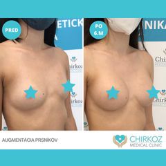 Zväčšenie prsníkov (Augmentácia) - Chirkoz Medical Clinic