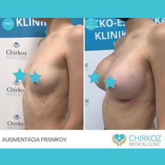 Zväčšenie prsníkov (Augmentácia) - Chirkoz Medical Clinic