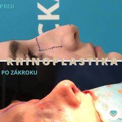 Operácia nosa (Rhinoplastika) - Chirkoz Medical Clinic