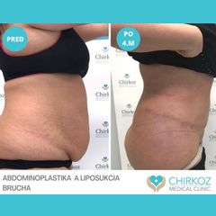 Abdominoplastika - Chirkoz Medical Clinic