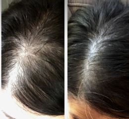 Vypadávanie vlasov - Chirkoz Medical Clinic