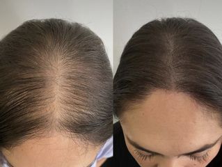 Vypadávanie vlasov - Chirkoz Medical Clinic