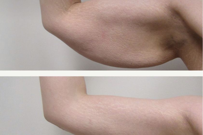 Liposukcia pred a po - 856695