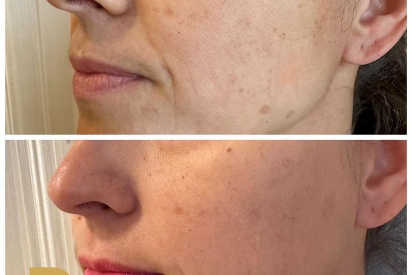 Laserová dermatológia pred a po - 854321