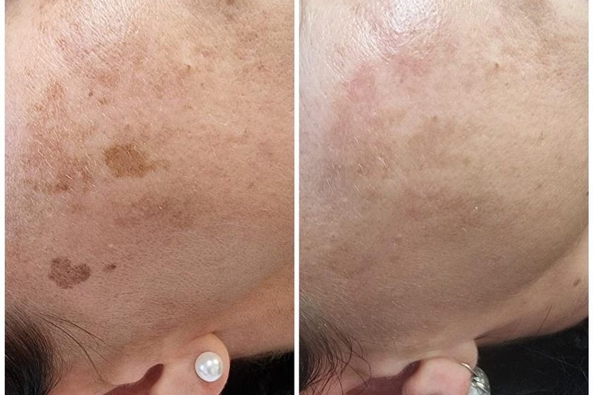 Laserová dermatológia pred a po - 854323