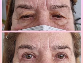 Blefaroplastika - 853498