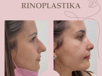 Rhinoplastika - 851731