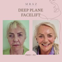 Facelift - MUDr. Ján Mráz