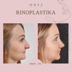 Rhinoplastika - MUDr. Ján Mráz