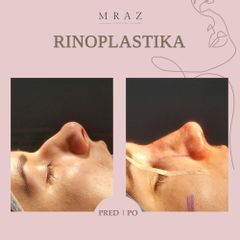 Rhinoplastika - MUDr. Ján Mráz