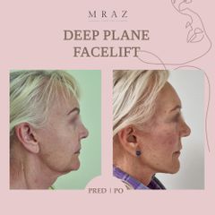 Facelift - MUDr. Ján Mráz