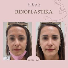 Rhinoplastika - MUDr. Ján Mráz