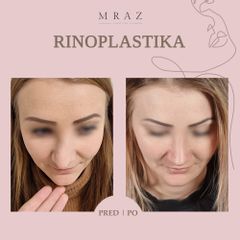 Rhinoplastika - MUDr. Ján Mráz