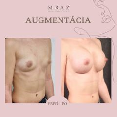 Zväčšenie pŕs - MUDr. Ján Mráz