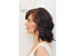 Facelift, SMAS facelifting - Klinika YES VISAGE