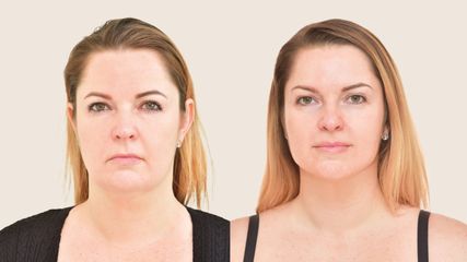 Niťový lifting - Klinika YES VISAGE