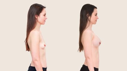 Zväčšenie prsníkov (Augmentácia) - Klinika YES VISAGE