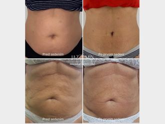 Neinvazívna liposukcia pred a po - 858288