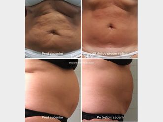 Neinvazívna liposukcia pred a po - 858289