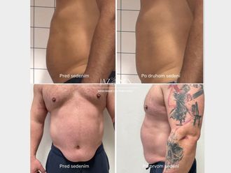 Neinvazívna liposukcia pred a po - 858290