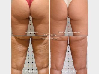 Neinvazívna liposukcia pred a po - 858291